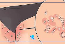 زگیل تناسلی چیست؟